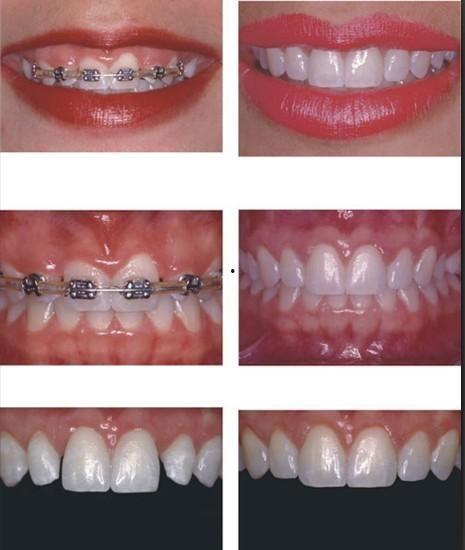 成人嘴部矫正视频大全教程,成人嘴部矫正视频教程大全